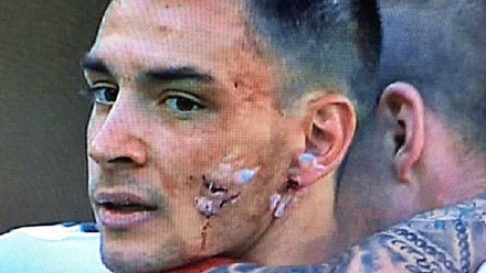 血腥!米兰铁卫面部遭钢钉踩踏 23岁帅哥或